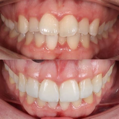 Find Affordable Invisalign Treatment Near You Today