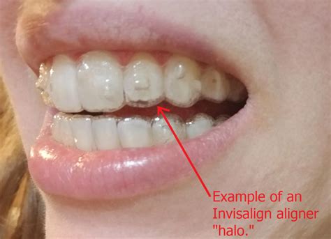Invisalign Treatment: Top Dentist Ranked for Results