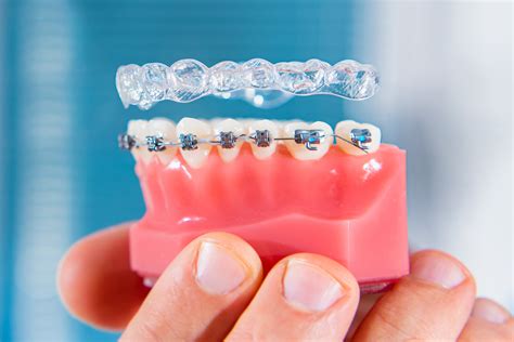 Invisible Braces Australia: Transform Your Smile Without Noticeable Appliances