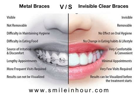 Invisible Braces Benefits: The Ultimate Guide to Subtle Teeth Alignment