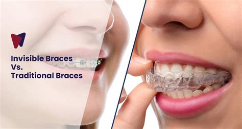 Discover the Invisible Braces Best Clinic for Perfect Smiles