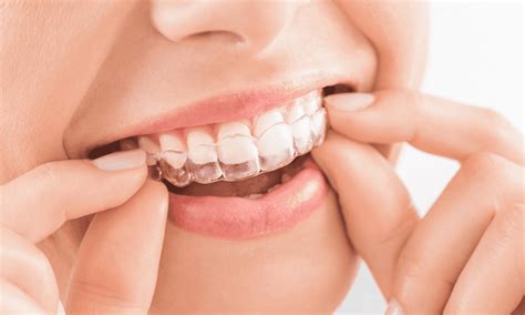 Invisible Braces Canada: Transform Your Smile in 2023!