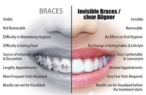 New York's Invisible Braces Price: Is It Affordable?