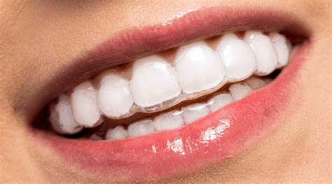 Exploring Invisible Braces Cost in UK: Surprising Savings Await!