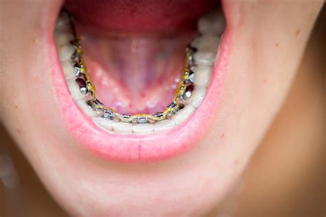 Invisible Braces London: Your Ultimate Guide to Discreet Teeth Alignment