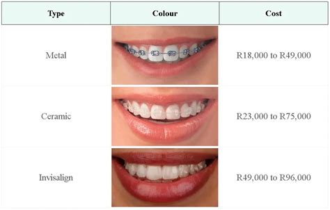 Affordable Invisible Braces Payment Plan Revealed