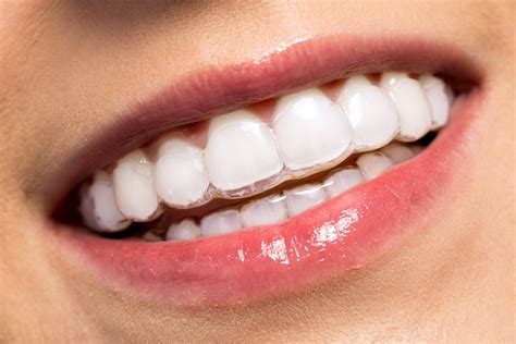 Invisible Braces Recovery Time: Your Quick Guide to Healing Fast