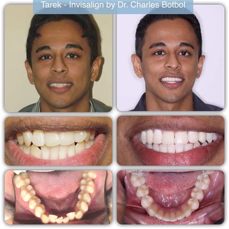 Invisible Braces Toronto: Transform Smiles Discreetly