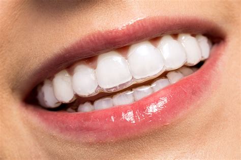Invisible Braces UK: Transform Smiles Today