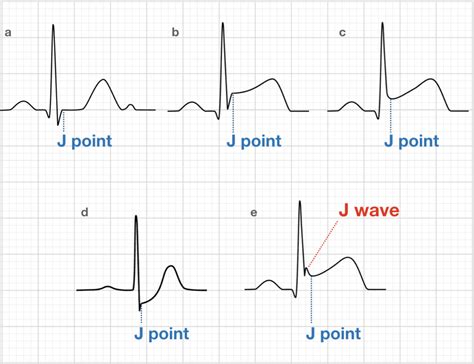 J Wave Ecg