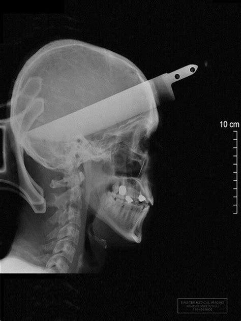 What A Knife In Head X Ray Looks Like On Images
