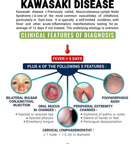 Understanding The Longterm Effects Of Kawasaki Disease