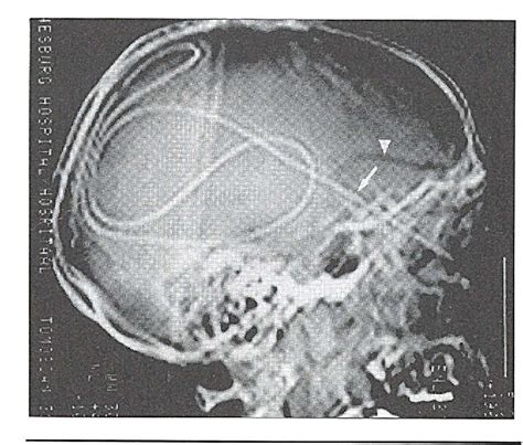What A Brain X Ray Shows About An Ng Tube Placement