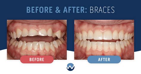 Orthodontic Treatment for Enduring Long Lasting Results