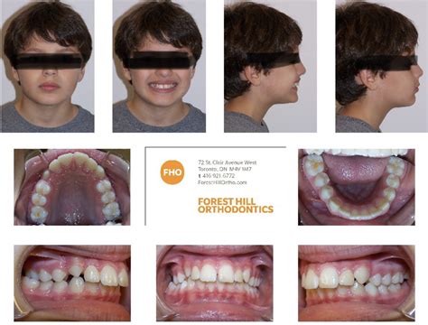 Discover Top Orthodontic Treatment Toronto Experts for a Perfect Smile