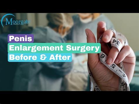 Penis Surgery Cost