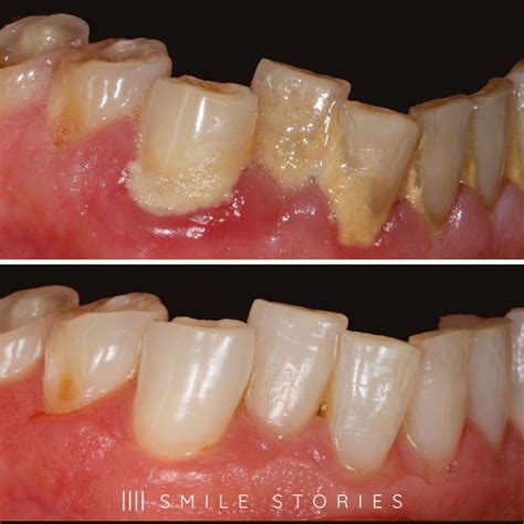 Periodontal Treatment Before and After: Transformation Unveiled