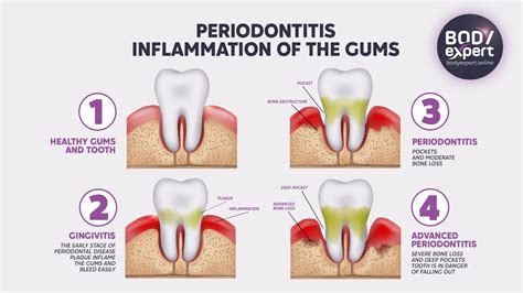 Periodontal Treatment Risks Unveiled: What You Should Know
