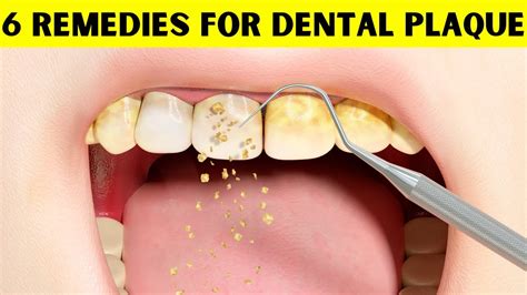 Plaque Removal Home Remedies Revealed