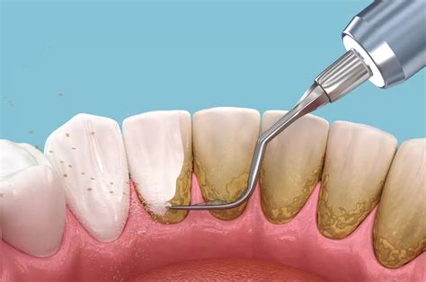 Plaque Removal Long Term Care: Effective Strategies for Lifelong Oral Health