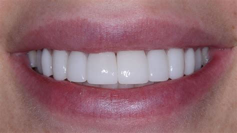 Get Stunning Porcelain Veneers with 24 Hour Service