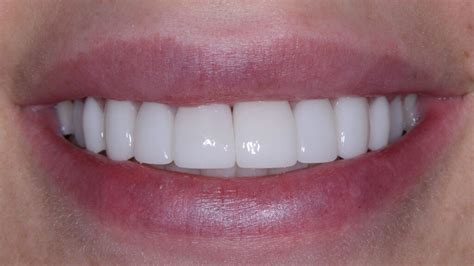 Ultimate Porcelain Veneers Complete Guide Uncovered