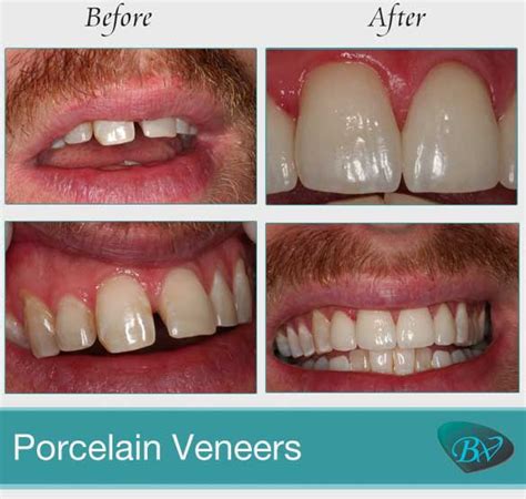 Los Angeles Porcelain Veneers Cost Insights