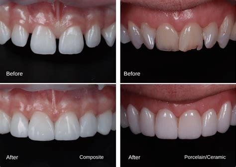 UK Porcelain Veneers Cost Breakdown 2023