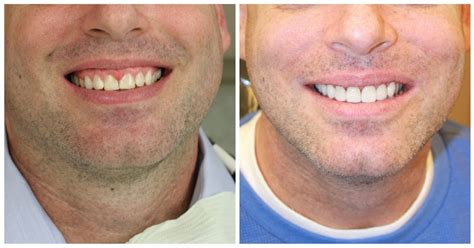 Best Porcelain Veneers New York Transformations