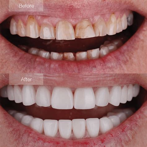 Affordable Porcelain Veneers Payment Plan Available Now