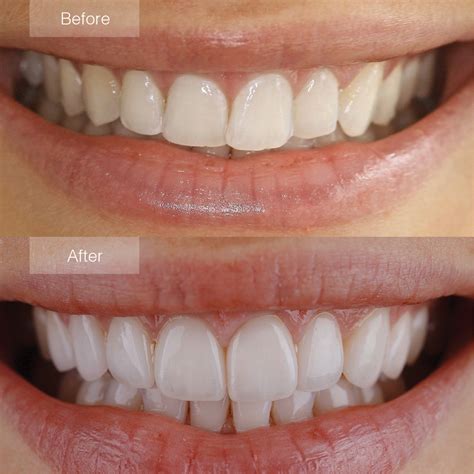 Transform Smiles: Stunning Porcelain Veneers Results