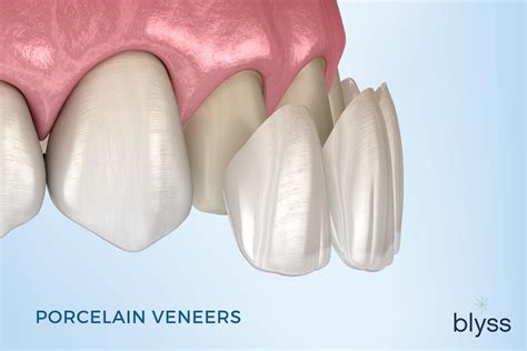 Expert Porcelain Veneers Specialist Transforms Smiles