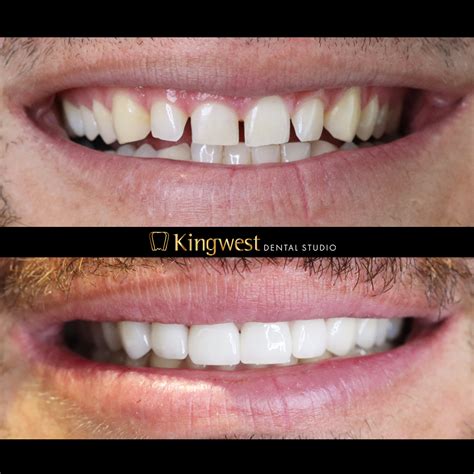 Top Porcelain Veneers Toronto Options Revealed