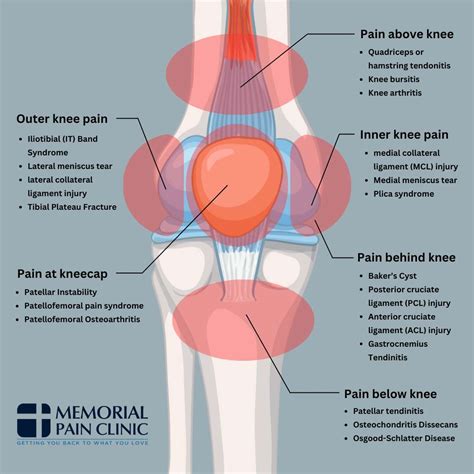 The Primary Cause Of Knee Pain That You Shouldn't Ignore