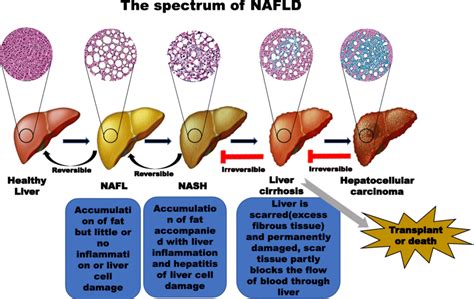 Uncovering The Primary Cause Of Nafld: What Really Drives It