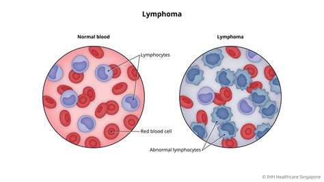 Primary Causes Of Lymphoma: Key Risk Factors Explained