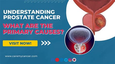 Primary Causes Of Prostate Cancer Explained