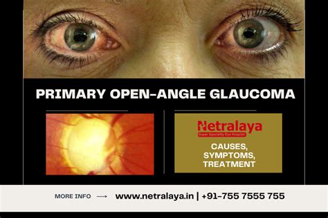 Primary Symptoms Of Open Angle Glaucoma To Watch For