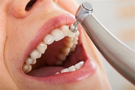 Top Secrets of Professional Teeth Cleaning Treatment
