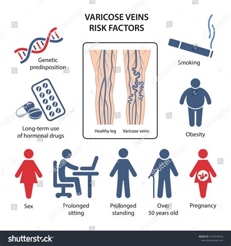 Uncovering The Top Risk Factors For Varicose Veins