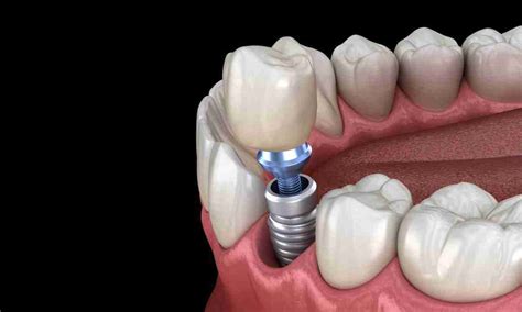 Uncovering the Truth: Same Day Dental Implants Cost in New York