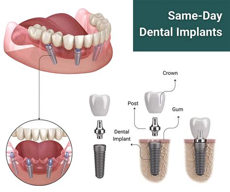 Unleash Affordable Same Day Dental Implants in Toronto: What's the Cost?