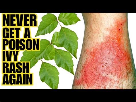 Warning Signs Of Severe Cases Of Poison Oak You Can't Ignore