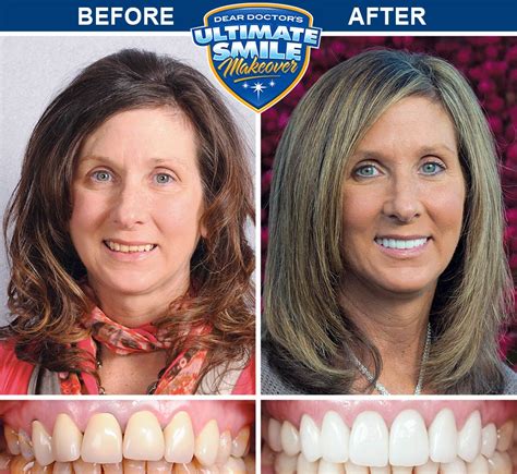Smile Makeover Canada: Transform Your Smile Today