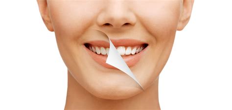 Top Smile Makeover Insurance Coverage Guide