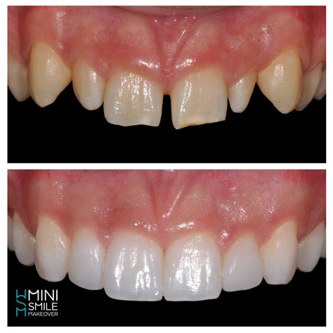 Smile Makeover: Long-Lasting Results Secrets Revealed