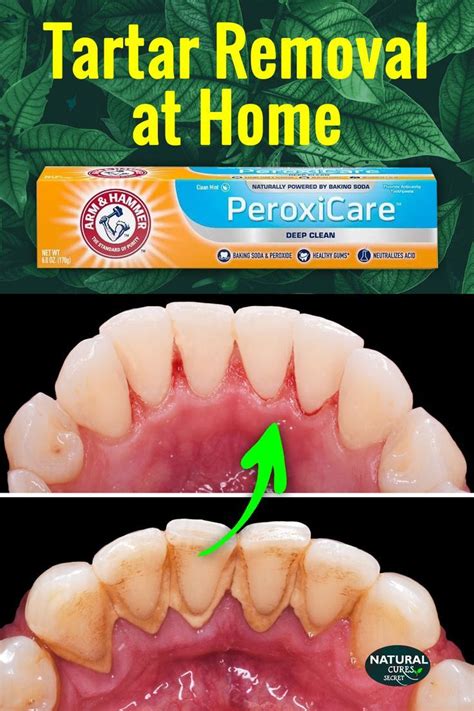 Optimal Tartar Removal Daily Routine for Cleaner Teeth