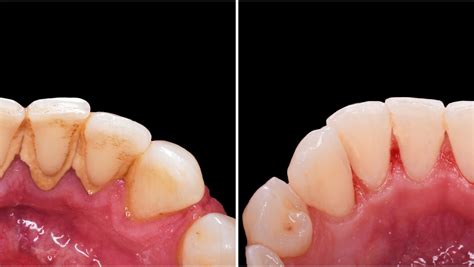 Teeth Cleaning Before and After: Stunning Transformations Revealed