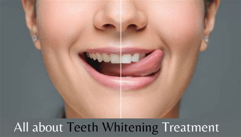 Ultimate Teeth Whitening Treatment Guide