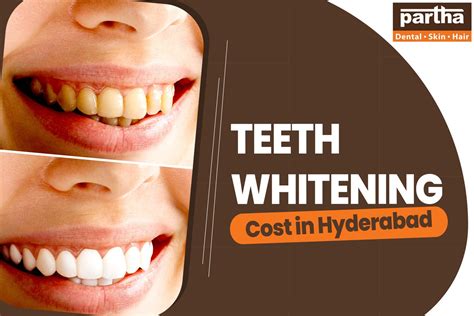 Unveiling the Affordable Teeth Whitening Treatment Cost: Your Guide to Brilliant Smiles